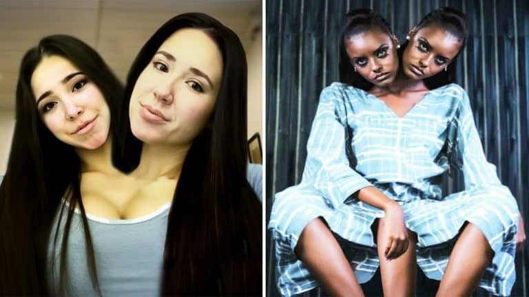 What Happens When One Conjoined Twin Dies What Happens When One Conjoined Twin Dies